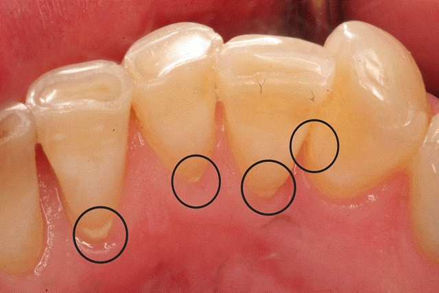 Cách nhận biết cao răng đang tích t
